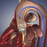 Edwards SAPIEN aortic valve replacement device.