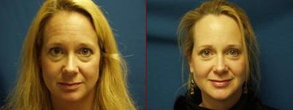 Before and After Botox Injection around the Eyes Before and After Botox Injection around the Eyes