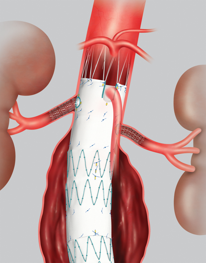 Fenestrated endograft