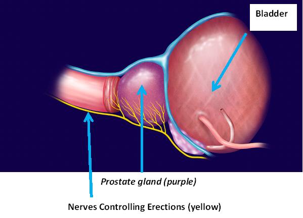 prostatectomy-prostate-cancer-surgery-what-to-expect-what-your