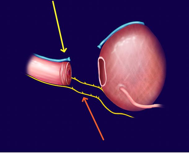 Robotic Prostatectomy Renaissance School Of Medicine At Stony Brook University 