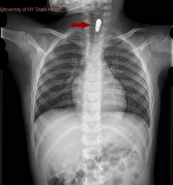 Chest X-Ray of Little Boy Showing Toy Part Lodged in His Esophagus