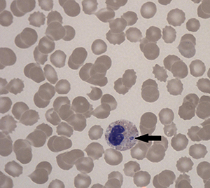 Anaplasmosis