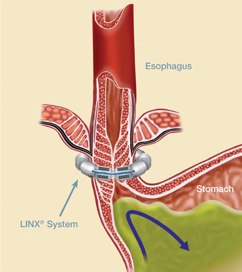 LINX Illustration