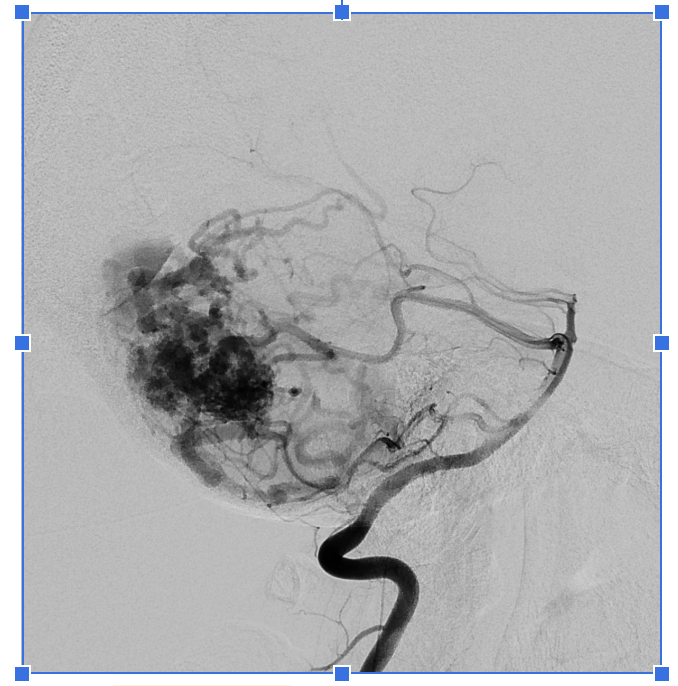 Non-Invasive Imaging for Brain AVM