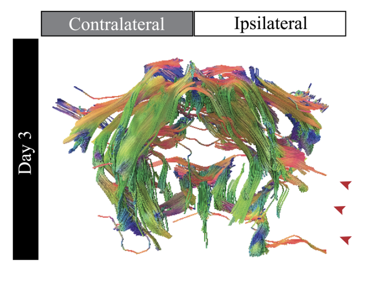 DTI of a Stroke DTI of a Stroke