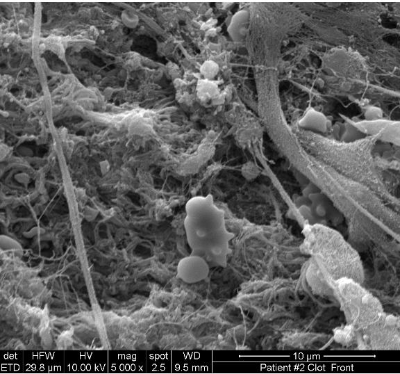 SEM of a Human Stroke Clot SEM of a Human Stroke Clot