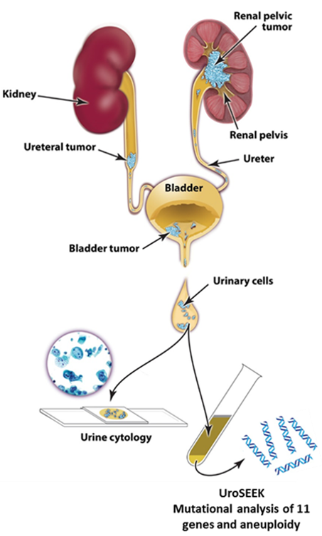 Early Detection Of Urothelial Cancers With Uroseek Renaissance School Of Medicine At Stony 8990