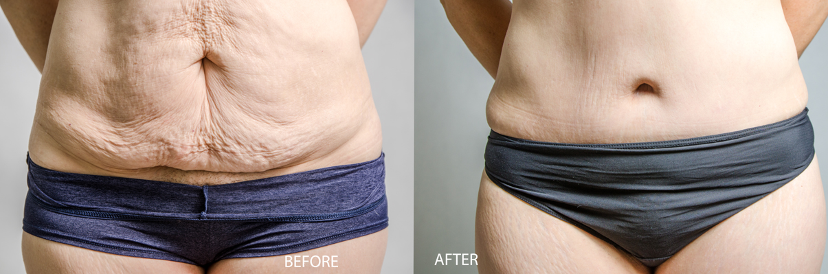 Before After Tummy Tuck 