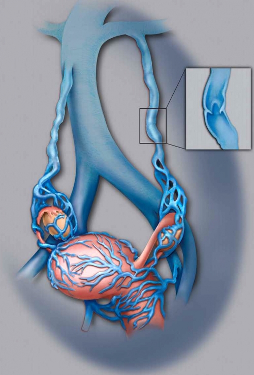 Pelvic venous disorder with close-up of varicose vein. an image is here